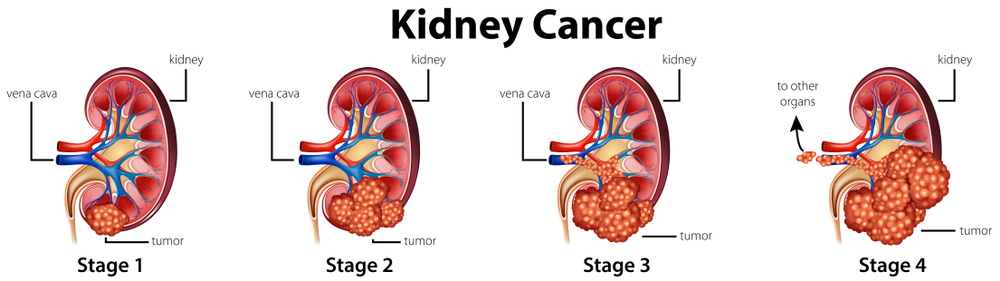 Best Kidney Cancer Treatment in Noida