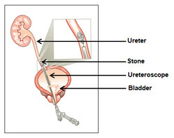urs surgery for kidney stone