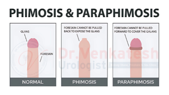 paraphimosis - Dr. Venkatesh