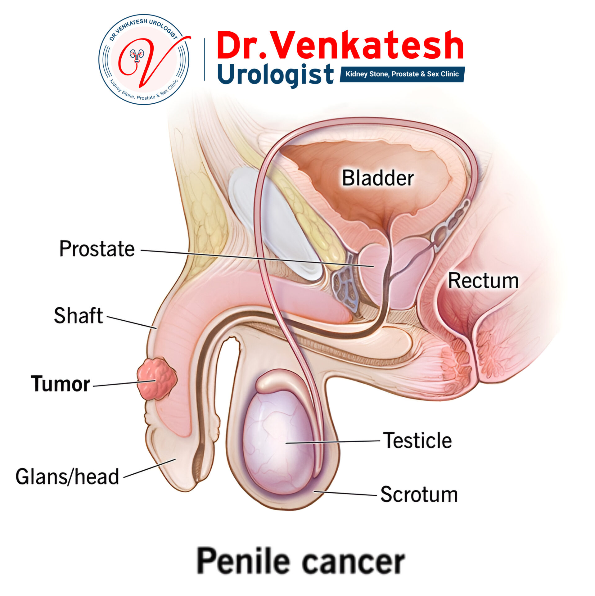 Penile Cancer