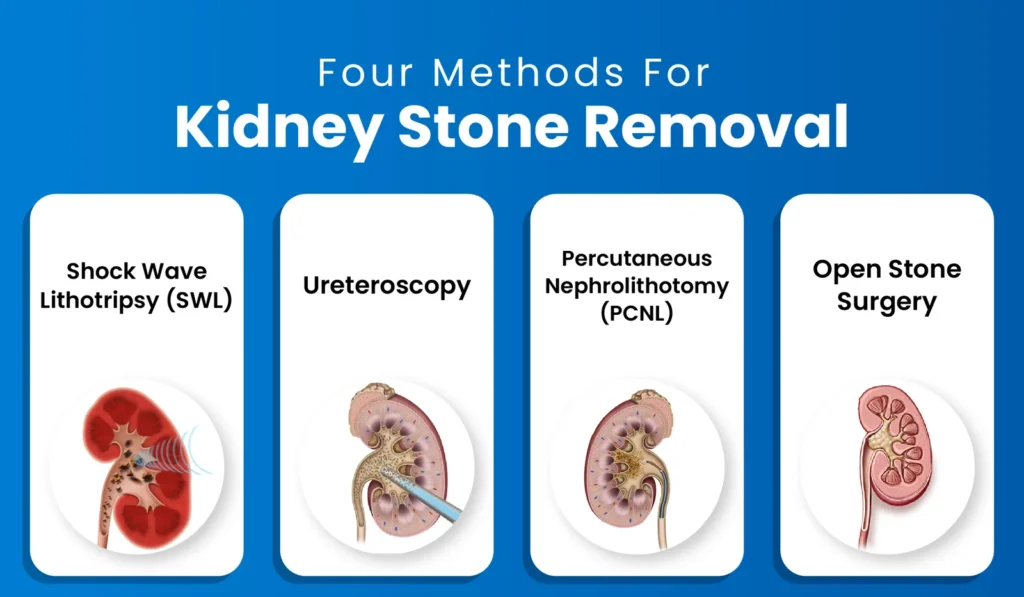kidney stone removal