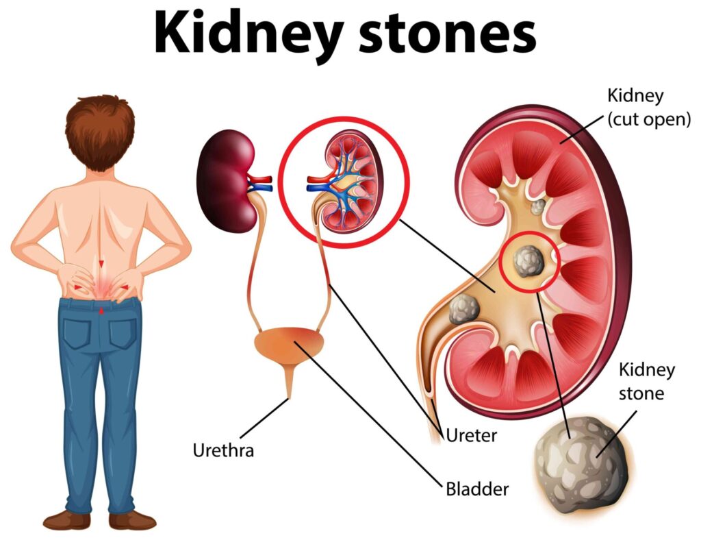 kidney stone causes