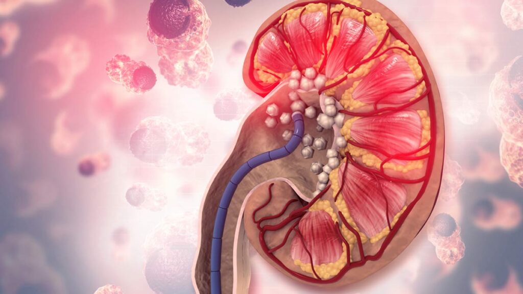 kidney stone noida