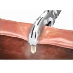 Best Rezum therapy in Noida